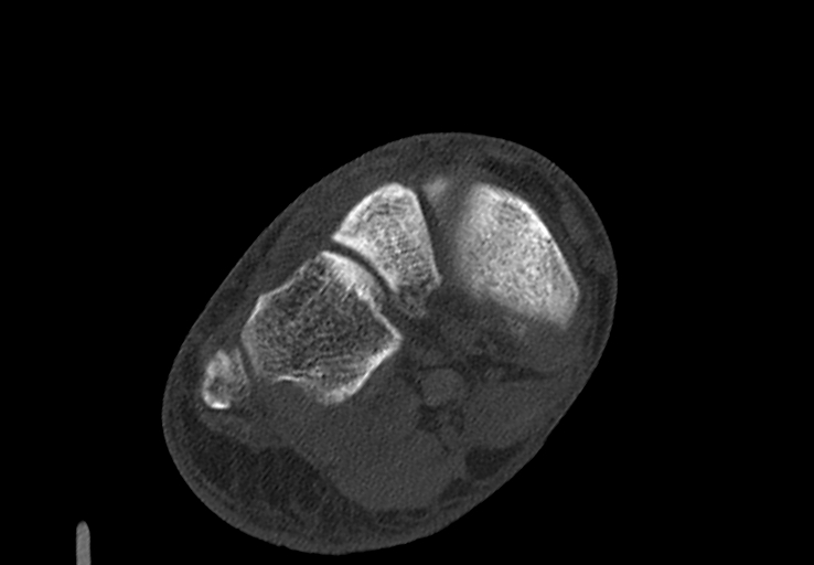 File:Advanced osteomyelitis due to open metatarsal fracture (Radiopaedia 83891-99095 Axial bone window 21).jpg