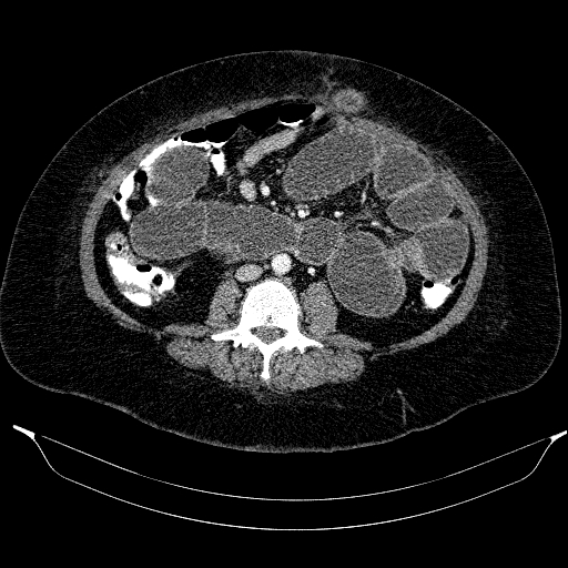 Afferent loop syndrome - secondary to incarcerated trocar site hernia (Radiopaedia 82959-97305 Axial C+ portal venous phase 130).jpg
