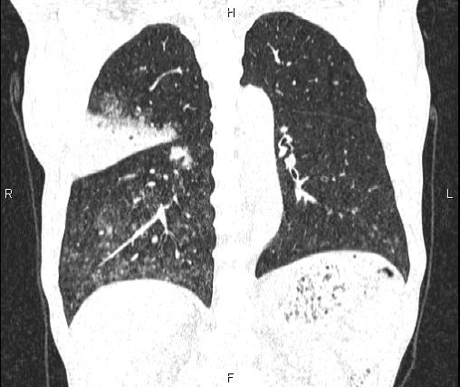 Air bronchogram in pneumonia (Radiopaedia 85719-101512 Coronal lung window 39).jpg