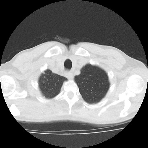 Allergic bronchopulmonary aspergillosis (ABPA) (Radiopaedia 60594-68313 Axial lung window 6).jpg
