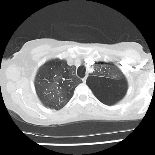 File:Alpha-1-antitrypsin deficiency (Radiopaedia 64893-73840 Axial lung window 9).jpg