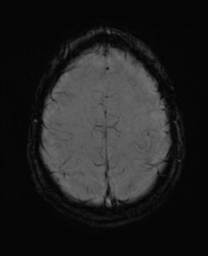 File:Alzheimer's disease- with Gerstmann syndrome and dressing apraxia (Radiopaedia 54882-61150 Axial SWI 28).png