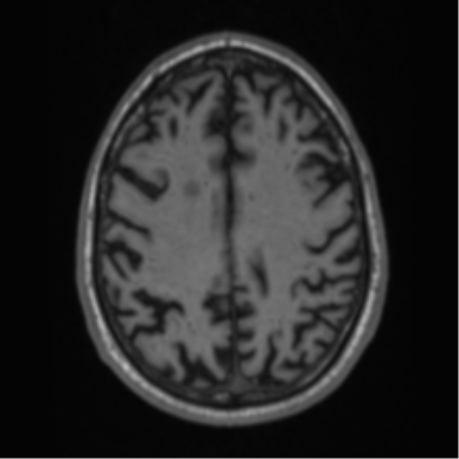 Alzheimer's disease- with Gerstmann syndrome and dressing apraxia (Radiopaedia 54882-61150 Axial T1 54).png