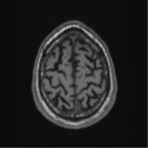 Alzheimer's disease- with Gerstmann syndrome and dressing apraxia (Radiopaedia 54882-61150 Axial T1 65).png