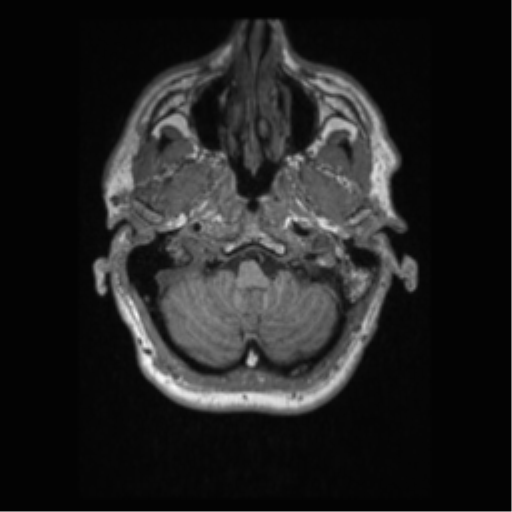 File:Alzheimer disease - probable (Radiopaedia 35334-36837 Axial T1 14).png