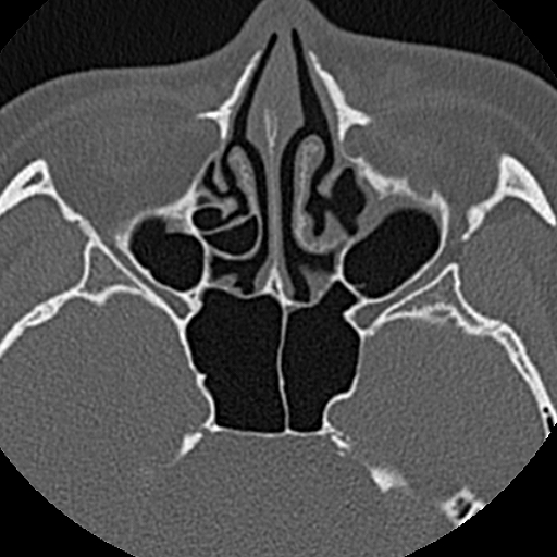 Ameloblastic fibro-odontoma (Radiopaedia 18843-18780 C 2).jpg