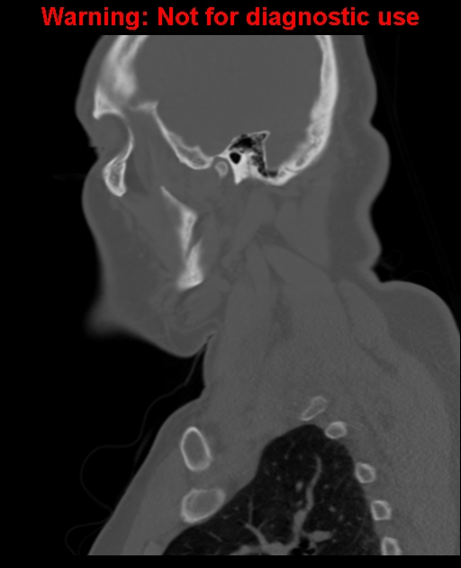 Ameloblastoma (Radiopaedia 33126-34164 Sagittal bone window 56).jpg