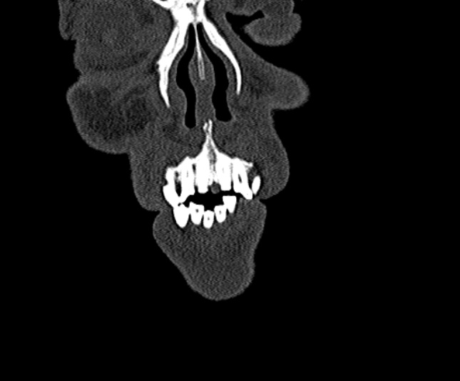 Ameloblastoma (Radiopaedia 51921-57766 Coronal bone window 12).jpg