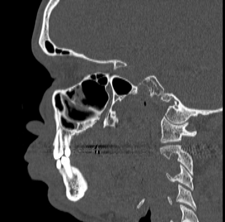 Ameloblastoma (Radiopaedia 77750-89997 Sagittal bone window 16).jpg