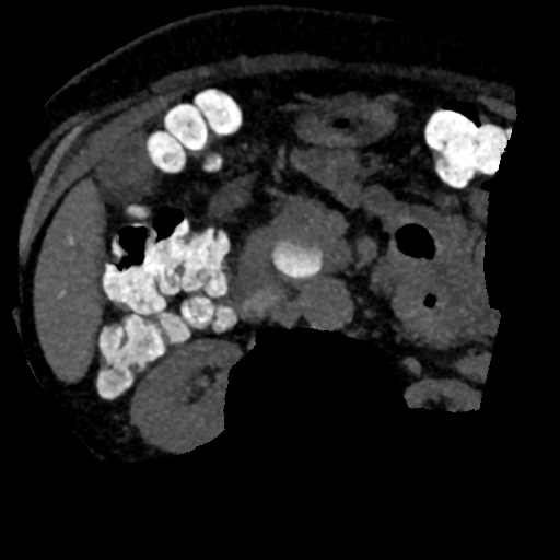 Ampullary adenocarcinoma (Radiopaedia 34013-35241 AXIAL MIPS 3-1.5 71).png