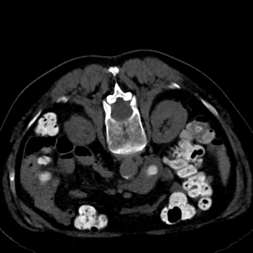 Ampullary adenocarcinoma (Radiopaedia 34013-35241 C 51).png