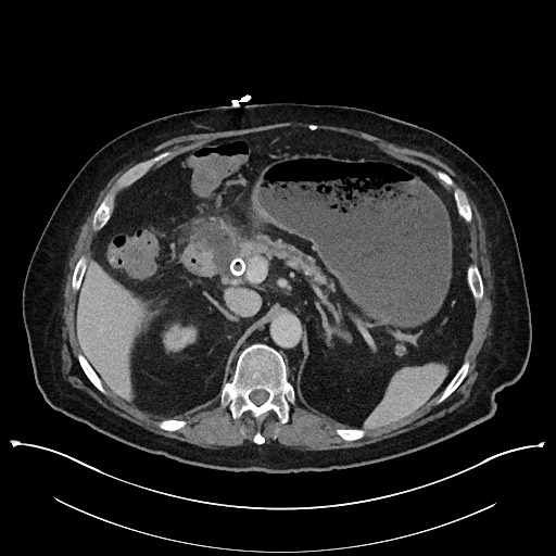 Ampullary adenocarcinoma (Radiopaedia 59373-66737 A 53).jpg
