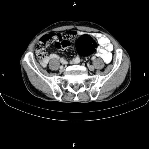 Ampullary adenocarcinoma (Radiopaedia 86093-102032 A 43).jpg