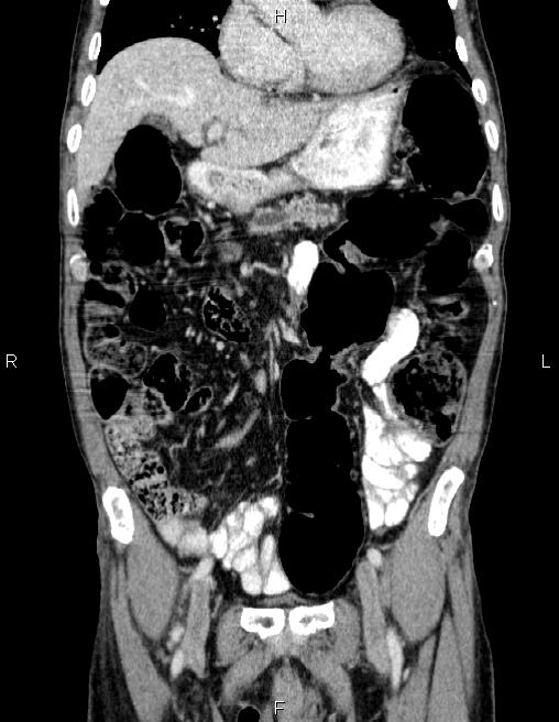 Ampullary adenocarcinoma (Radiopaedia 86093-102032 C 24).jpg
