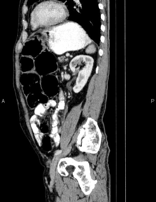 Ampullary adenocarcinoma (Radiopaedia 86093-102032 D 68).jpg