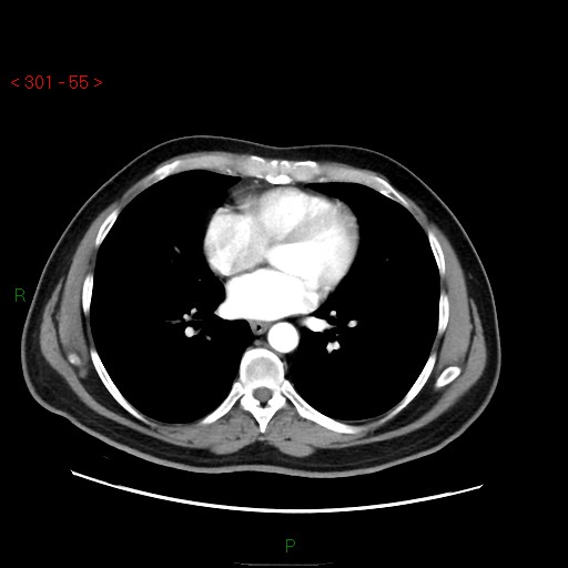 Ampullary carcinoma (Radiopaedia 56396-63056 B 1).jpg