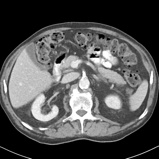 File:Amyand hernia (Radiopaedia 39300-41547 A 21).png