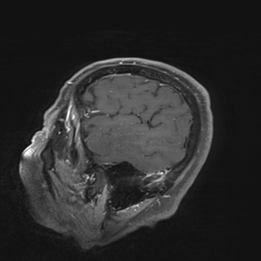 Amyloid angiopathy with inflammation (Radiopaedia 30360-31002 M 151).jpg