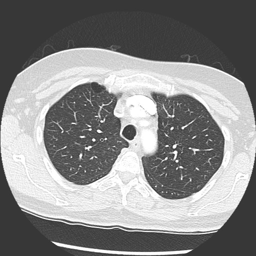 Amyloidosis - bronchial and diffuse nodular pulmonary involvement (Radiopaedia 60156-67745 Axial lung window 19).jpg