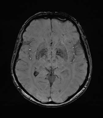 Anaplastic astrocytoma (Radiopaedia 86943-103160 Axial SWI 44).png