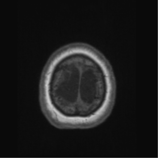 Anaplastic astrocytoma IDH wild-type (pseudoprogression) (Radiopaedia 42209-45276 Axial T1 141).png
