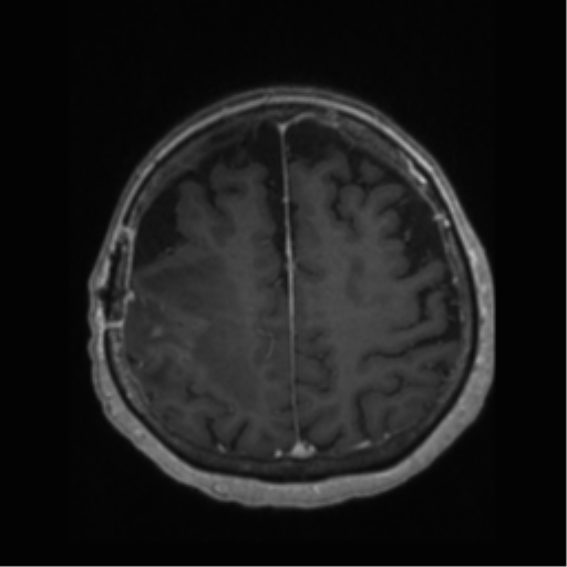 File:Anaplastic astrocytoma IDH wild-type (pseudoprogression) (Radiopaedia 42209-45277 Axial T1 C+ 94).png