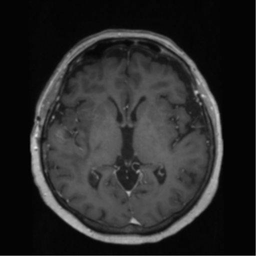 File:Anaplastic astrocytoma IDH wild-type (pseudoprogression) (Radiopaedia 42209-45278 Axial T1 C+ 81).png