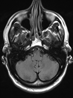 File:Anaplastic meningioma with recurrence (Radiopaedia 34452-35788 Axial T2 FLAIR 5).png