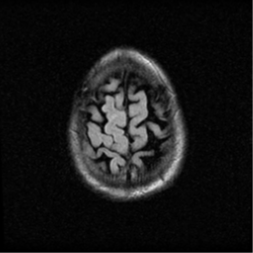 File:Anaplastic meningioma with recurrence (Radiopaedia 34452-35789 Axial FLAIR 21).png