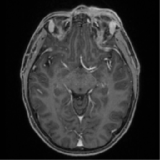 Anaplastic oligodendroglioma with skull fracture (Radiopaedia 74831-85845 Axial T1 C+ fat sat 26).png