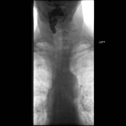 File:Anastomotic stricture post Ivor Lewis esophagectomy (Radiopaedia 47937-52715 Frontal 2).png