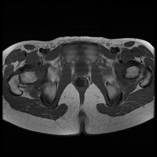 File:Androgen insensitivity syndrome (Radiopaedia 38585-40727 Axial T1 22).jpg