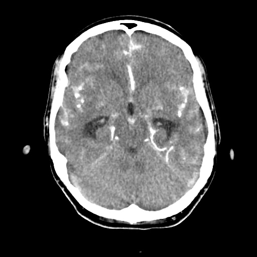 Aneursym related subarachnoid hemorrhage with hydrocephalus (Radiopaedia 45105-49084 D 20).jpg