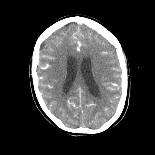 Aneursym related subarachnoid hemorrhage with hydrocephalus (Radiopaedia 45105-49084 D 34).jpg
