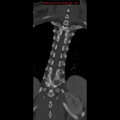 File:Aneurysmal bone cyst (Radiopaedia 9419-10102 Coronal bone window 16).jpg