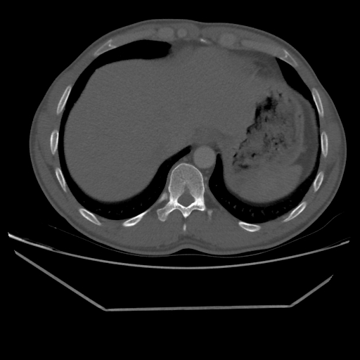 File:Aneurysmal bone cyst - rib (Radiopaedia 82167-96220 Axial bone window 212).jpg