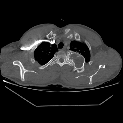 Aneurysmal bone cyst - rib (Radiopaedia 82167-96220 Axial bone window 67).jpg