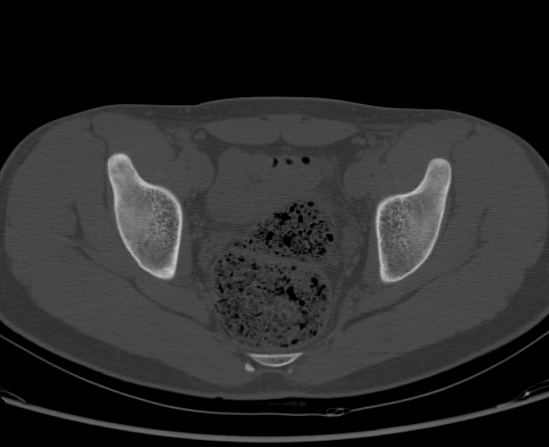 File:Aneurysmal bone cyst of ischium (Radiopaedia 25957-26094 Axial bone window 47).png
