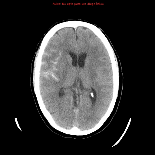 File:Aneurysmal subarachnoid hemorrhage (Radiopaedia 24740-24997 Axial non-contrast 22).jpg