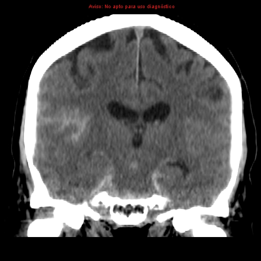 File:Aneurysmal subarachnoid hemorrhage (Radiopaedia 24740-24997 Coronal non-contrast 25).jpg