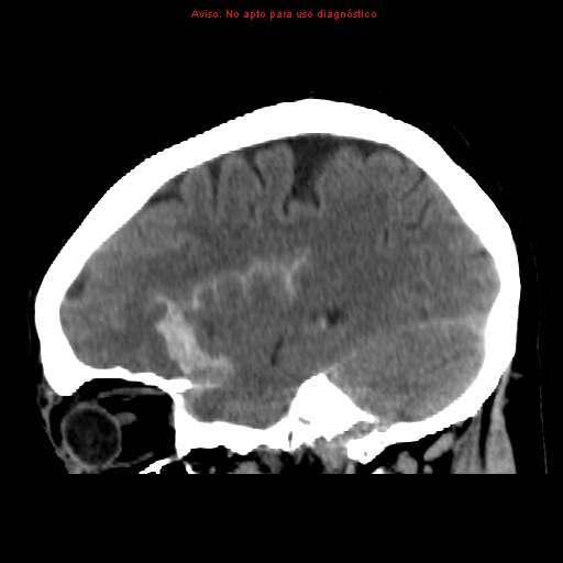 File:Aneurysmal subarachnoid hemorrhage (Radiopaedia 24740-24997 non-contrast 14).jpg