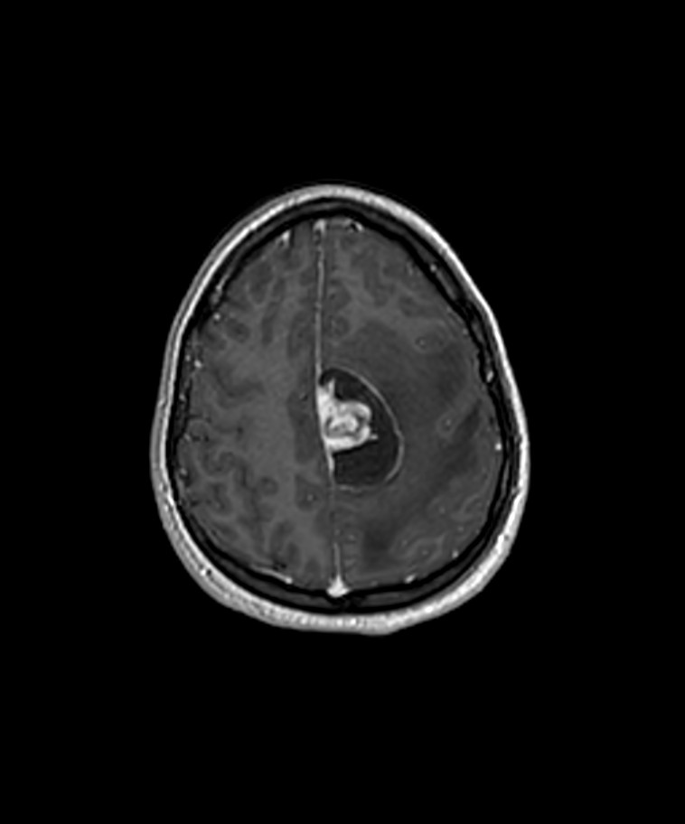 Angiomatous meningioma (Radiopaedia 79459-92577 Axial T1 C+ 3D ISO 41).jpg