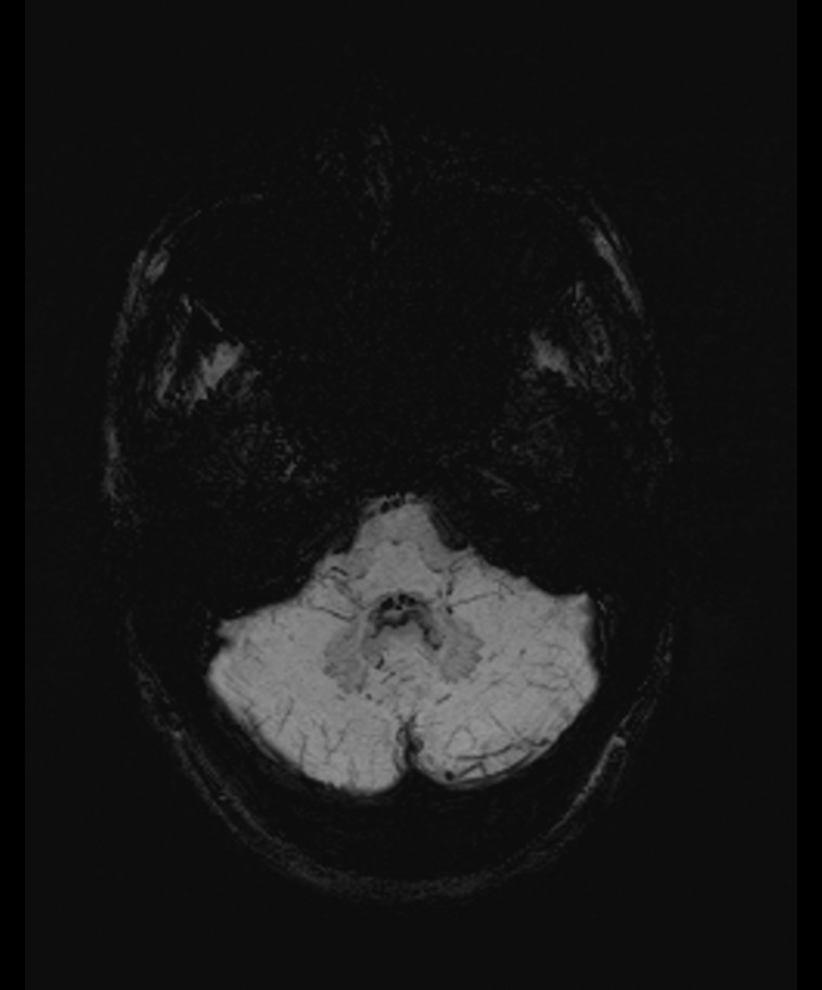 Angiomatous meningioma (Radiopaedia 79459-92579 E 11).jpg