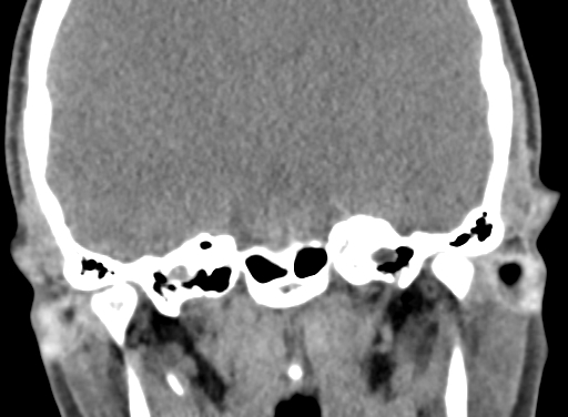 Angular dermoid cyst (Radiopaedia 88967-105790 Coronal non-contrast 69).jpg