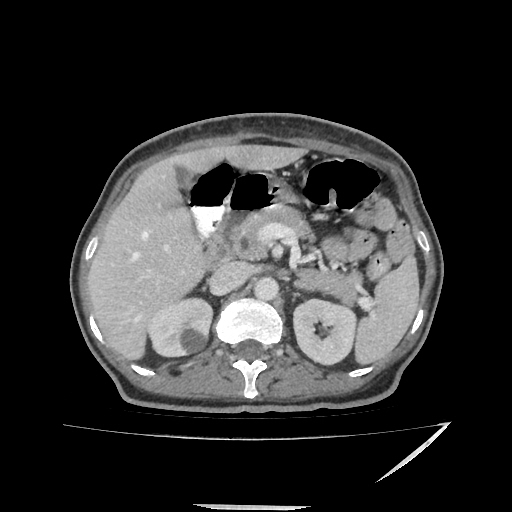 File:Anorectal carcinoma (Radiopaedia 44413-48064 A 16).jpg