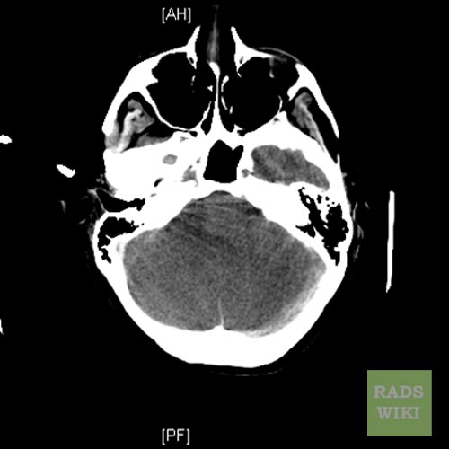 File:Anoxic brain injury (Radiopaedia 11191-11556 Axial 1).jpg