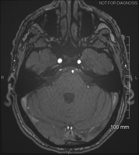Anterior cerebral artery aneurysm (Radiopaedia 80683-94127 Axial MRA 60).jpg