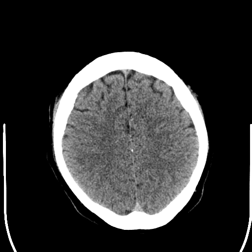 File:Anterior cerebral artery territory infarct (Radiopaedia 39327-41581 Axial non-contrast 22).png