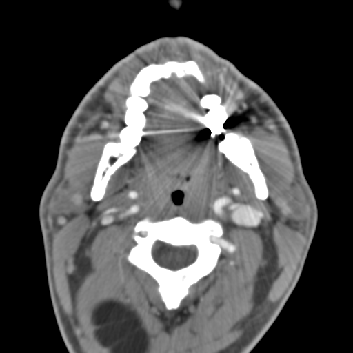 Anterior cerebral artery territory infarct (Radiopaedia 39327-41581 B 64).png