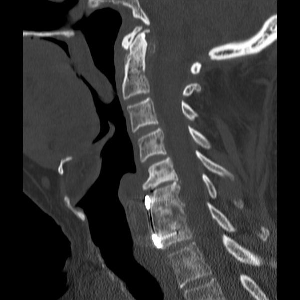 Anterior cervical postdiscectomy arthrodesis (Radiopaedia 32678-33646 Sagittal bone window 36).jpg